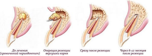 Резекция верхушки корня зуба 